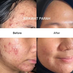 Jerawat Parah