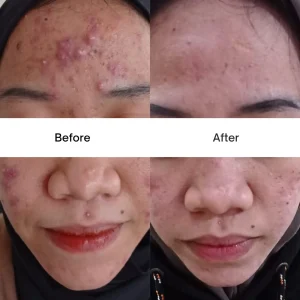 Acne Clear