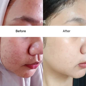 Bekas jerawat merah